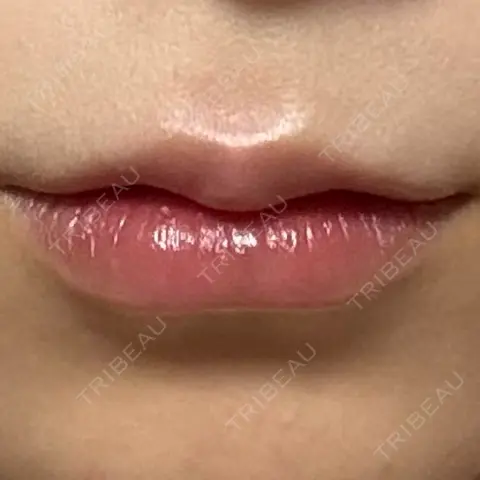 ヒアルロン酸注入（唇） AZ BEAUTY CLINIC DAY 0