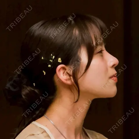 隆鼻術 / 鼻尖形成（切開） / 鼻中隔延長（切開） / 小鼻縮小（切開） / 軟骨移植 / 鼻尖縮小 ASTRA BEAUTY CLINIC AFTER