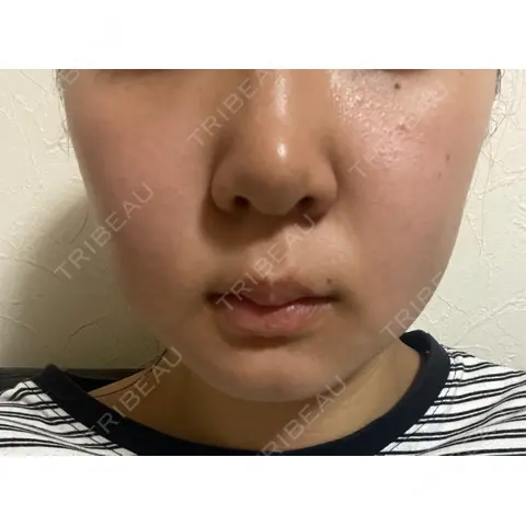 エレクトロポレーション / 光治療（フォトフェイシャルなど） 若倉診療所 AFTER