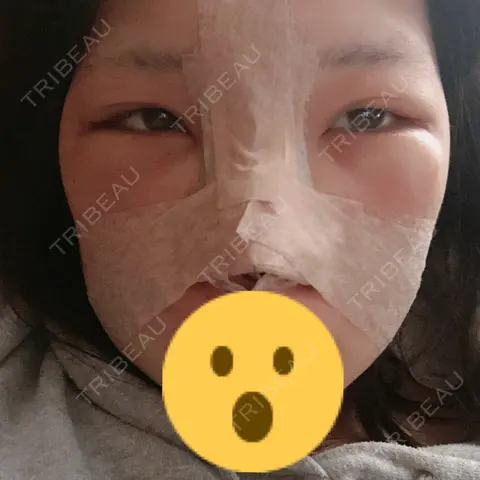 鼻尖形成（切開） / 小鼻縮小（切開） / 軟骨移植 / 眉間プロテーゼ 湘南美容クリニック 熊本院 DAY 2