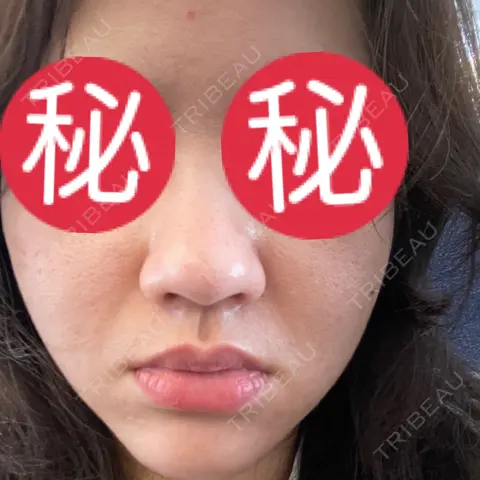 ポテンツァ L‘amour clinic Tokyo【ラムールクリニック東京】 AFTER