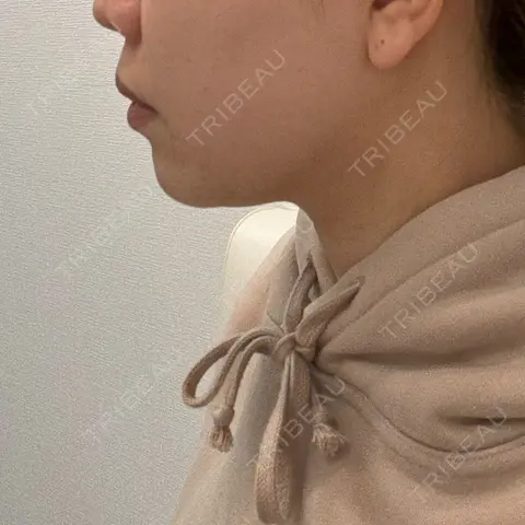 脂肪溶解注射（顔） フォンタナクリニック天神 AFTER