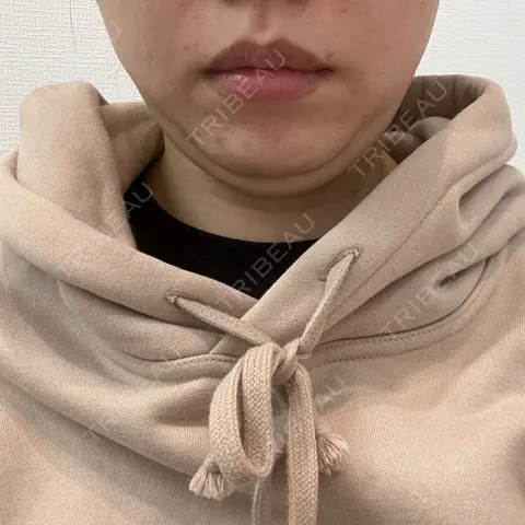 脂肪溶解注射（顔） フォンタナクリニック天神 AFTER