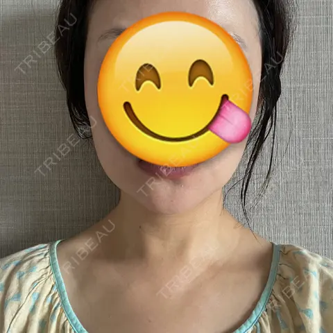 脂肪吸引（顔） Mods Clinic（モッズクリニック） 東京院 AFTER