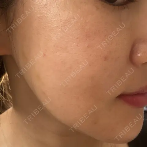 糸リフト PRO CLINIC プロクリニック 銀座院 AFTER