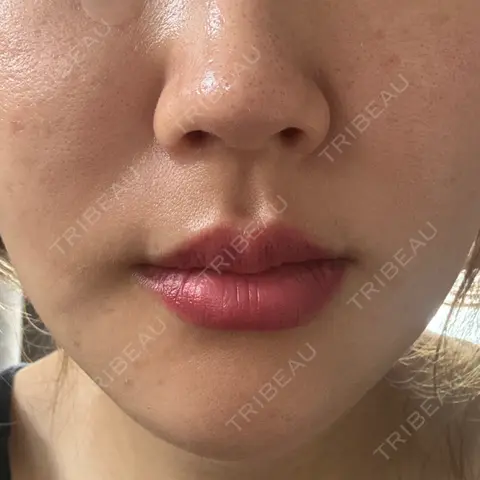 糸リフト PRO CLINIC プロクリニック 銀座院 AFTER