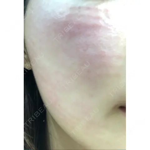 水光注射（ハリ・美肌） リエンジャン整形外科 江南店 DAY 0
