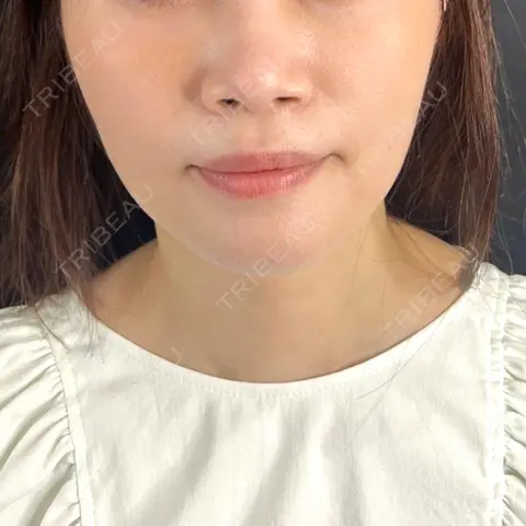 糸リフト 藤・ナチュレ美容クリニック 銀座院 AFTER