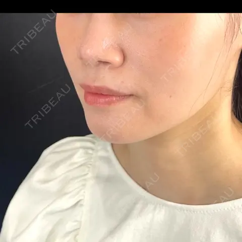 糸リフト 藤・ナチュレ美容クリニック 銀座院 AFTER