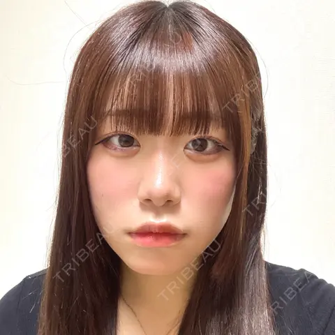 ヒアルロン酸注入（涙袋） / ヒアルロン酸注入（唇） 新宿Ladies&Gentlemen美容クリニック AFTER