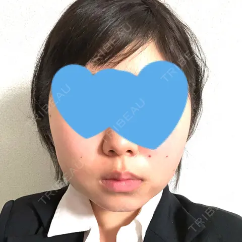 脂肪吸引（顔） GRACIA clinic 【グラシアクリニック】 DAY 1