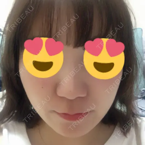 小鼻縮小（切開） 東京形成美容外科 船橋院 AFTER