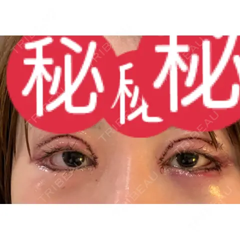 目頭切開 / 眼瞼下垂（切開） / 目尻切開 / タレ目形成・グラマラスライン（切開） / 目元修正 / 目尻靭帯移動 DIVINE（ディバイン）整形外科 DAY 0