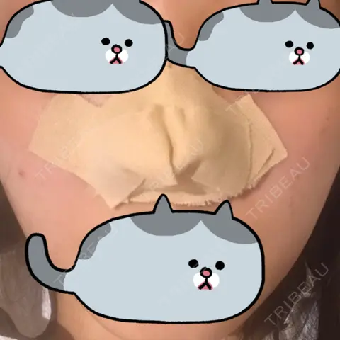 鼻尖形成（切開） / 軟骨移植 白山クリニック 大分 DAY 0