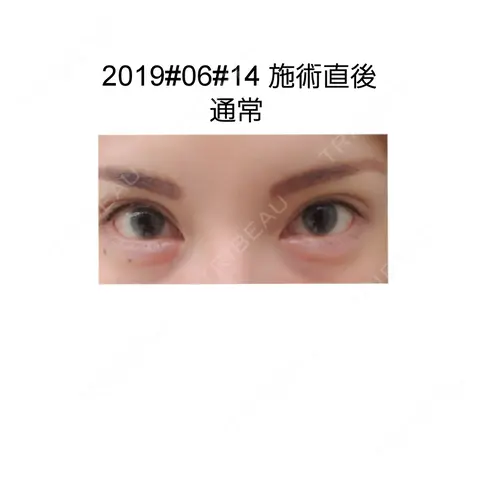 ヒアルロン酸注入（涙袋） 湘南美容クリニック 横浜院 DAY 0