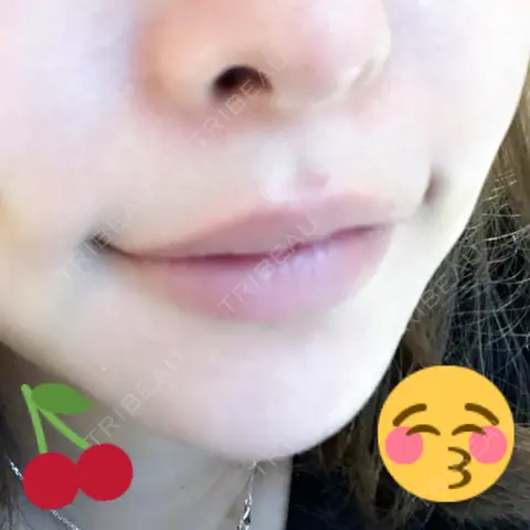 ヒアルロン酸注入（唇） 渋谷美容外科クリニック 池袋院 AFTER