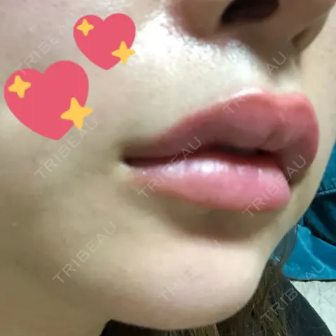 ヒアルロン酸注入（唇） 渋谷美容外科クリニック 池袋院 AFTER