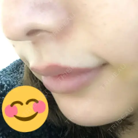 ヒアルロン酸注入（唇） 渋谷美容外科クリニック 池袋院 AFTER
