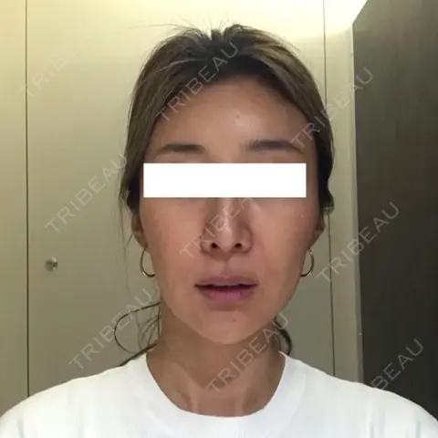 その他（輪郭） 東京イセアクリニック DAY 1