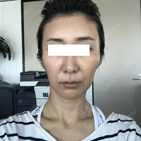 その他（輪郭） 東京イセアクリニック AFTER
