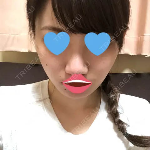 バッカルファット除去 / 脂肪吸引（顔） / ヒアルロン酸注入（鼻） 湘南美容クリニック 横浜東口院 AFTER