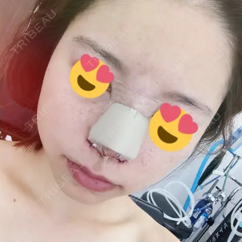 隆鼻術 / 鼻中隔延長（切開） / 小鼻縮小（切開） / 軟骨移植 湘南美容クリニック 神戸院 DAY 0