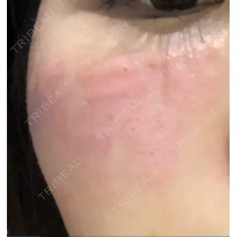 水光注射（ハリ・美肌） プチパーティー医院 DAY 0