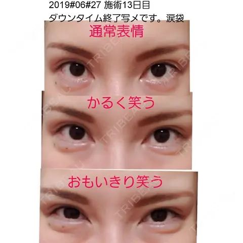 ヒアルロン酸注入（涙袋） 湘南美容クリニック 横浜院 AFTER