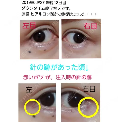 ヒアルロン酸注入（涙袋） 湘南美容クリニック 横浜院 AFTER
