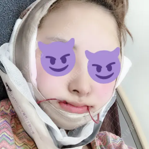 骨切り（あご） / 骨削り（エラ） / 骨削り（頬） / 脂肪吸引（顔） / ヒアルロン酸溶解 View美容整形外科 DAY 0