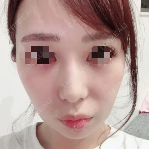 スレッドノーズ / ヒアルロン酸注入（涙袋） / ヒアルロン酸注入（鼻） / ボトックス（あご） / ヒアルロン酸注入（あご） / ボトックス（肩） / 美肌レーザー ニューセンス皮膚科クリニック AFTER