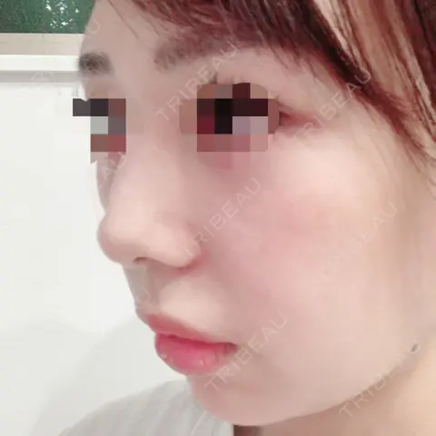 スレッドノーズ / ヒアルロン酸注入（涙袋） / ヒアルロン酸注入（鼻） / ボトックス（あご） / ヒアルロン酸注入（あご） / ボトックス（肩） / 美肌レーザー ニューセンス皮膚科クリニック AFTER