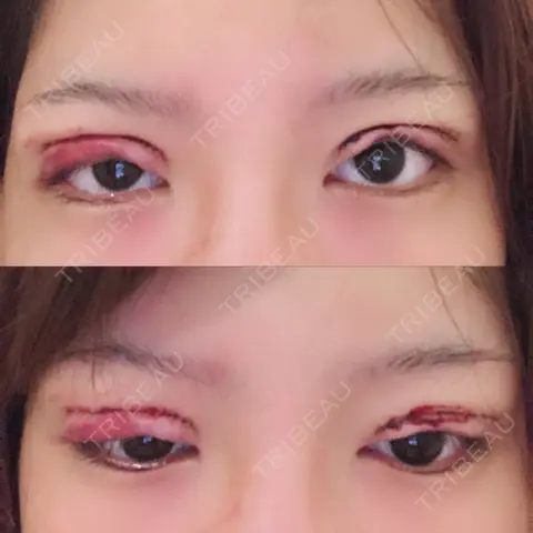 眼瞼下垂（切開） 大阪TAクリニック DAY 1