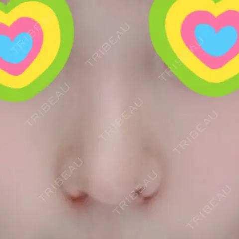 小鼻縮小（切開） プラストクリニック DAY 0