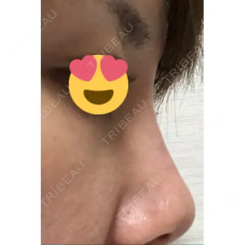 ヒアルロン酸注入（鼻） TCB東京中央美容外科 堺院 AFTER
