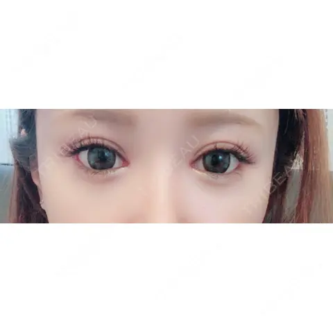 二重埋没 / 目頭切開 / 目尻切開 ジュエリー美容外科 AFTER