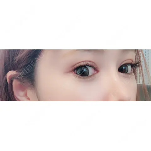 二重埋没 / 目頭切開 / 目尻切開 ジュエリー美容外科 AFTER