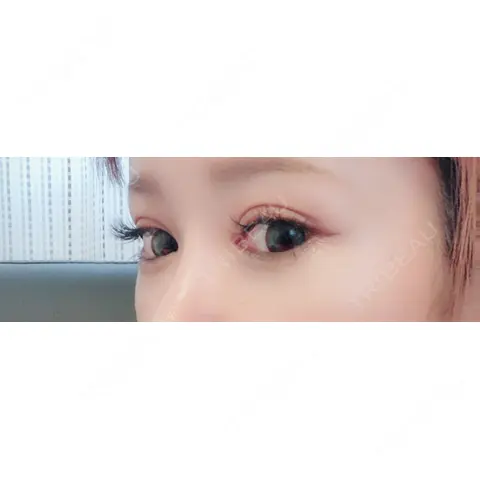 二重埋没 / 目頭切開 / 目尻切開 ジュエリー美容外科 AFTER