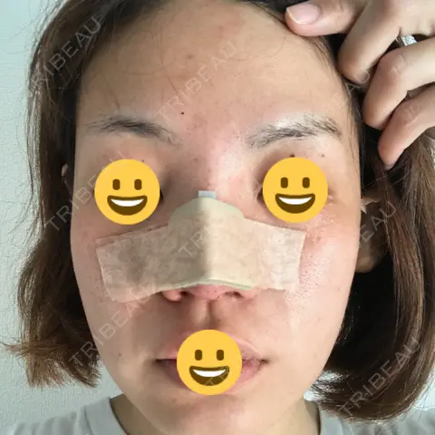 隆鼻術 / 鼻尖形成（切開） / 軟骨移植 湘南美容クリニック 千葉センシティ院 DAY 0