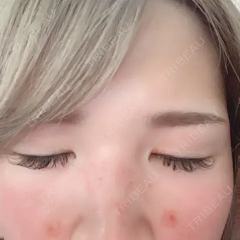 シミ取りレーザー 芦屋美容クリニック 芦屋院 DAY 0