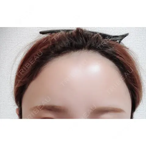脂肪注入（肌） / 再生医療 / PRP皮膚再生療法 iSTAR美容外科・皮膚科 AFTER