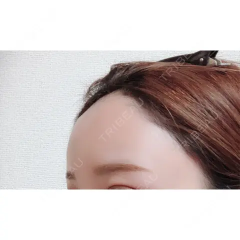 脂肪注入（肌） / 再生医療 / PRP皮膚再生療法 iSTAR美容外科・皮膚科 AFTER