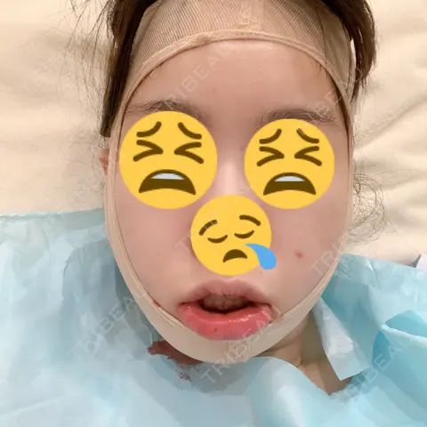 脂肪吸引（顔） / 輪郭修正 / その他（輪郭） リラ・クラニオフェイシャル・クリニック DAY 0