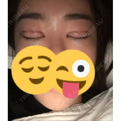 二重埋没 / 眼瞼下垂（切開） / 目尻切開 / 蒙古ひだ形成 / タレ目形成・グラマラスライン（切開） POP美容整形クリニック DAY 0