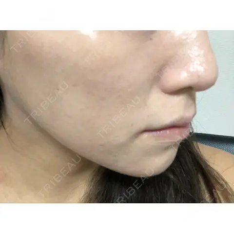 糸リフト / ハイフ（顔） TCB東京中央美容外科 渋谷西口院 AFTER