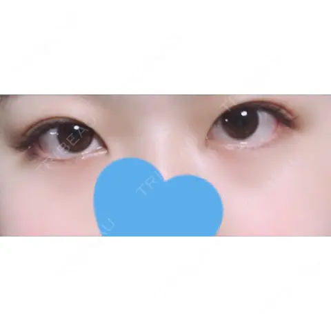 二重埋没 水の森美容クリニック 名古屋院 AFTER