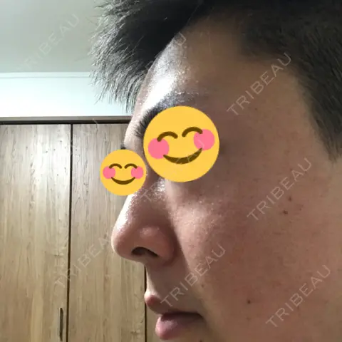 ほくろ・いぼ切除（肌） 大西皮フ科形成外科医院 京都四条烏丸院 AFTER