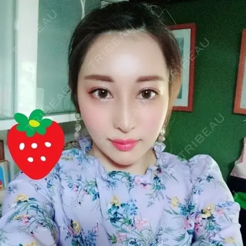 二重埋没 / 目頭切開 / 鼻尖形成（切開） / 鼻中隔延長（切開） / 軟骨移植 / ヒアルロン酸注入（鼻） / ヒアルロン酸注入（あご） 湘南美容クリニック 新潟院 AFTER