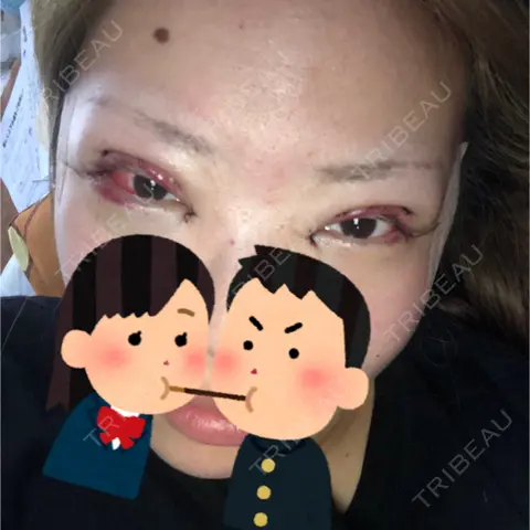 二重切開 / 目頭切開 / 目尻切開 湘南メディカル記念病院（両国） DAY 1