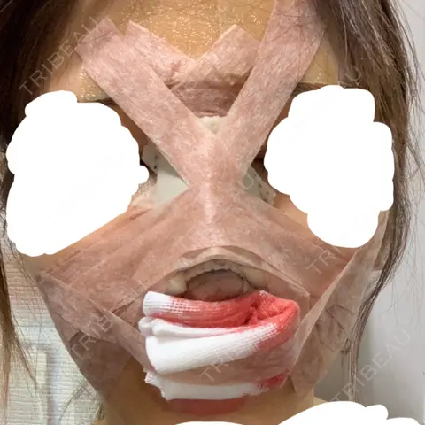 鼻尖形成（切開） / 小鼻縮小（切開） / 軟骨移植 / 骨切幅寄せ / 鼻修正 / 鼻翼基部形成（貴族手術） 加美（GAMI）整形外科 DAY 0